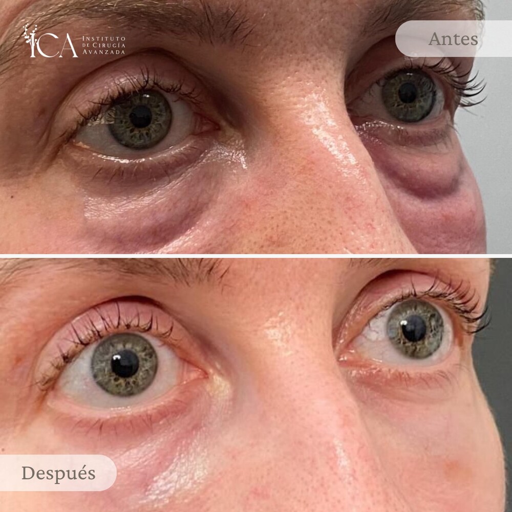 Before and After Result